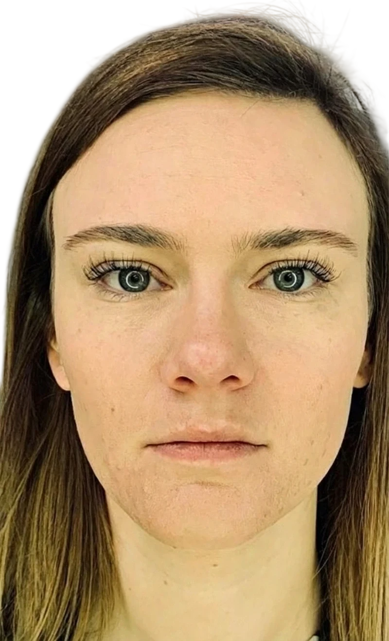 Hair Loss Microneedling after