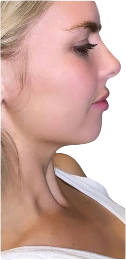 Jawline Filler before