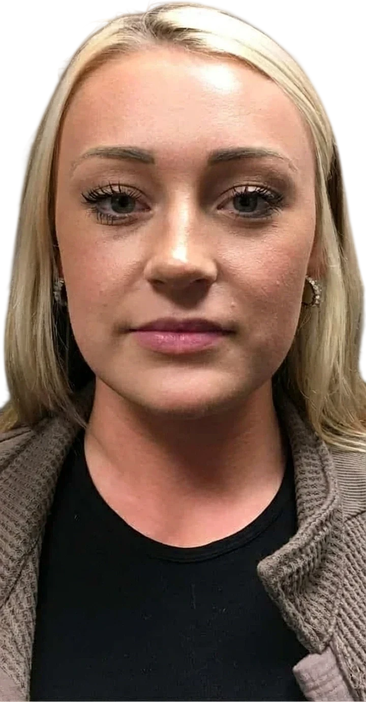 Under-Eye Filler before