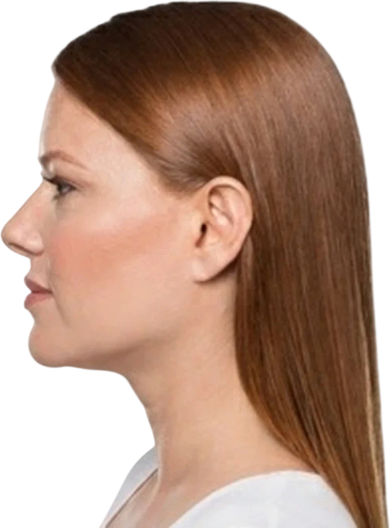 Kybella before