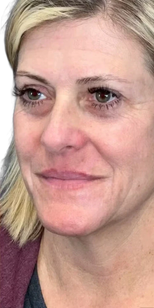 Everesse Jawline after