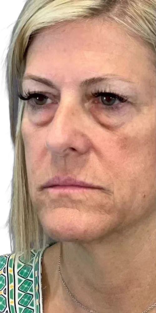 Everesse Neck before