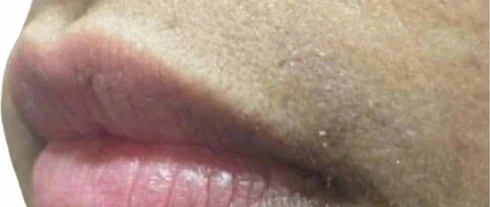 Laser Services after