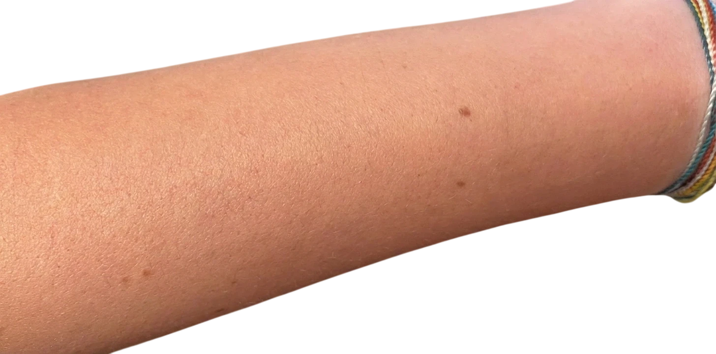 Laser Hair Removal after