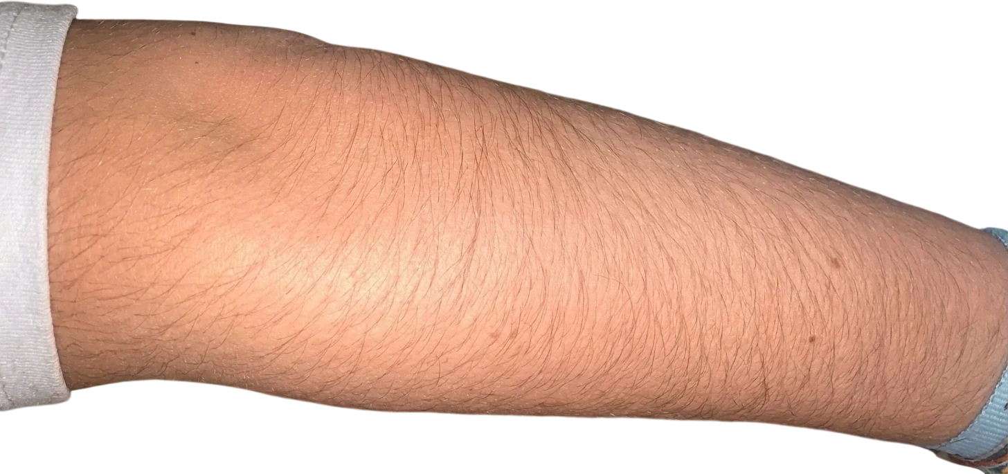 Laser Hair Removal before