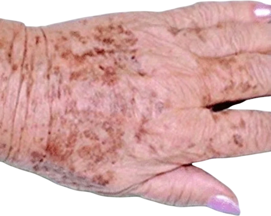 Pigmented Lesion Reduction before