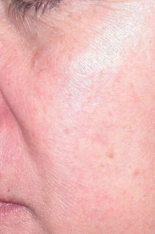 Vascular Lesion Reduction after