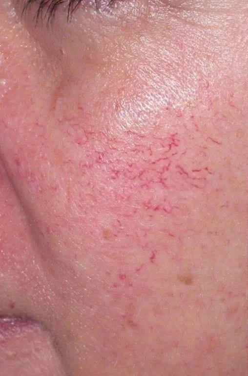 Vascular Lesion Reduction before