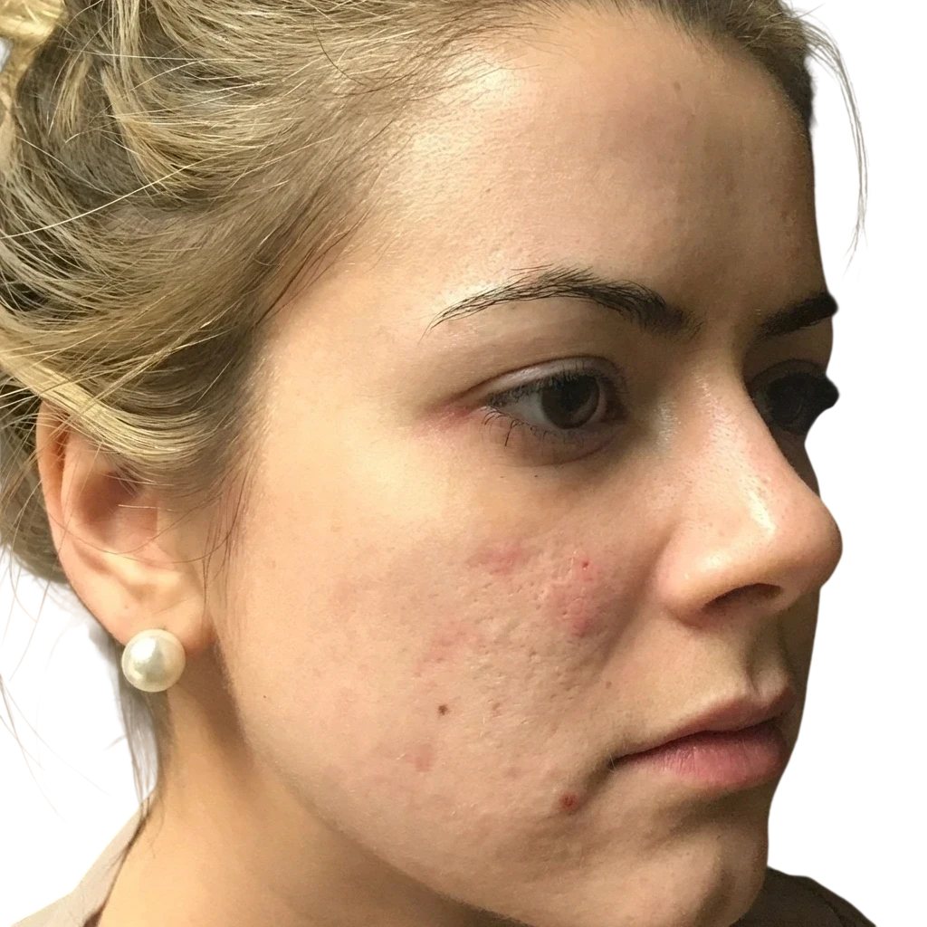 Hair Loss Microneedling after