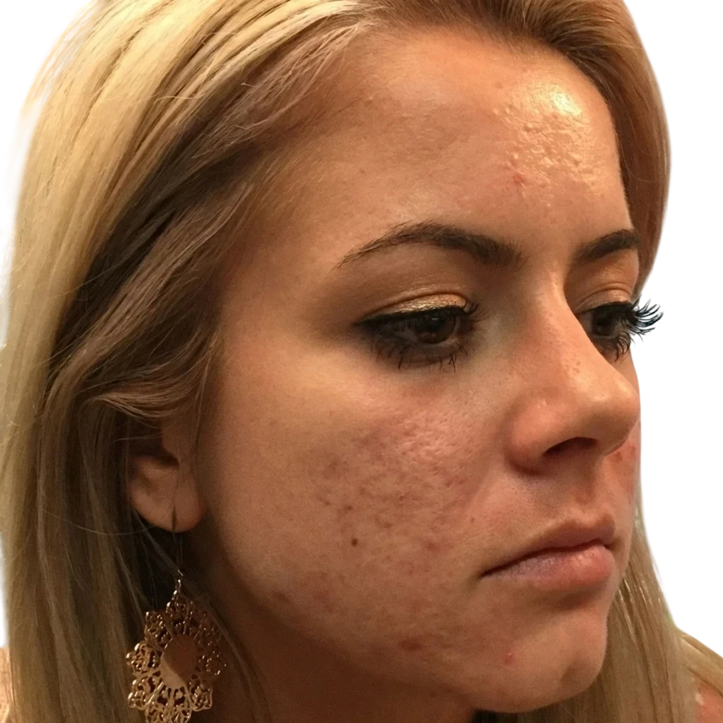 Hair Loss Microneedling before