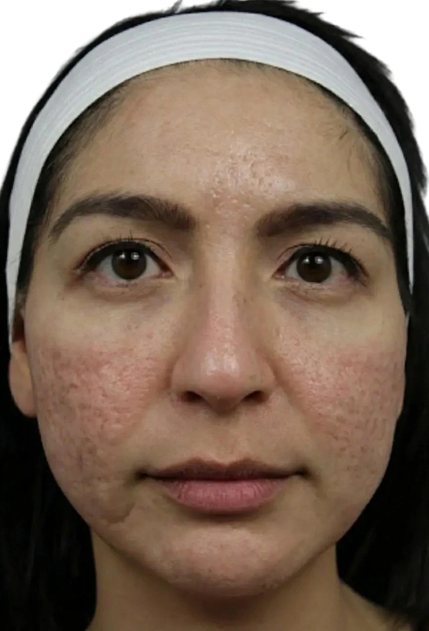 Face Microneedling before treatment at Sarah Hitchcox Aesthetics